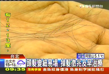 頭髮變細易塌　掉髮徵兆及早治療