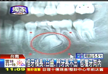 〈獨家〉怪牙橫長!臼齒、門牙長不出 包覆牙肉內