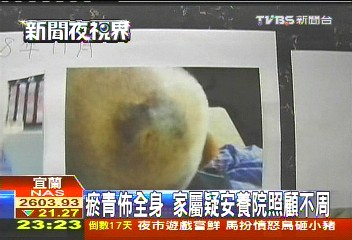 瘀青佈全身　家屬疑安養院照顧不周