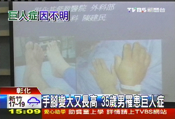 手腳變大又長高 35歲男罹患巨人症