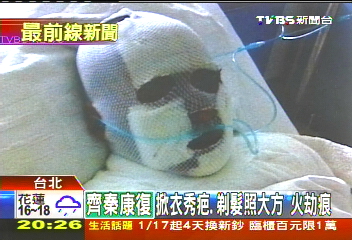 燒傷纏繃帶照曝光 齊秦復原良好