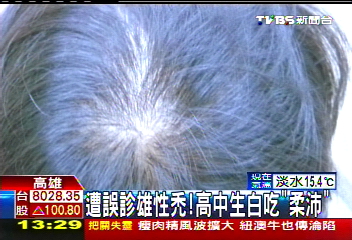 遭誤診雄性禿！　高中生白吃「柔沛」