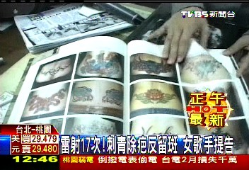 雷射17次！刺青除疤反留斑　女歌手提告