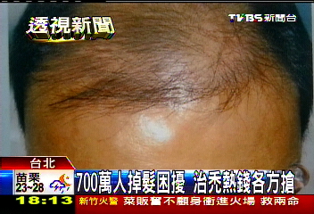 700萬人為掉髮所苦 健髮商機年增10%
