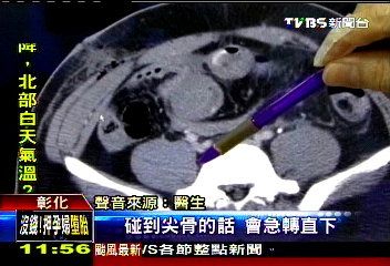 子彈在肚內轉彎！右腹挨槍　從左臀出