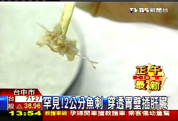罕見!2公分魚刺 穿透胃壁插肝臟