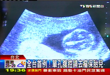 全台首例！　單孔腹腔鏡去瘤保胎兒
