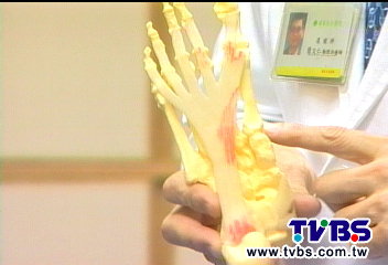 「光腳」運動缺緩衝　足底筋膜恐發炎