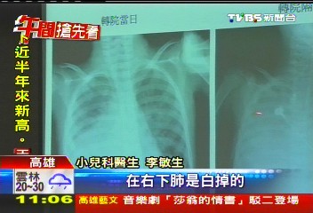 腹痛竟是肺炎！　女童接種過疫苗仍感染