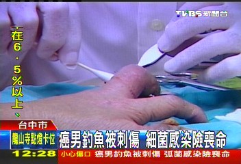 癌男釣魚被刺傷 細菌感染險喪命