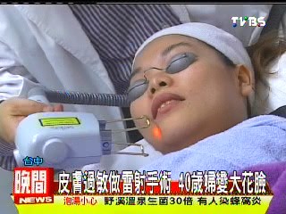 皮膚過敏做雷射手術 40歲婦變大花臉