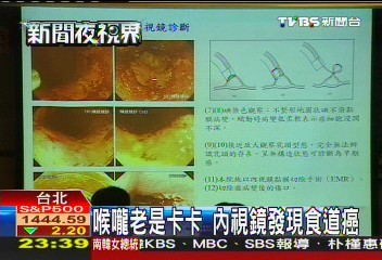 喉嚨老是卡卡 內視鏡發現食道癌