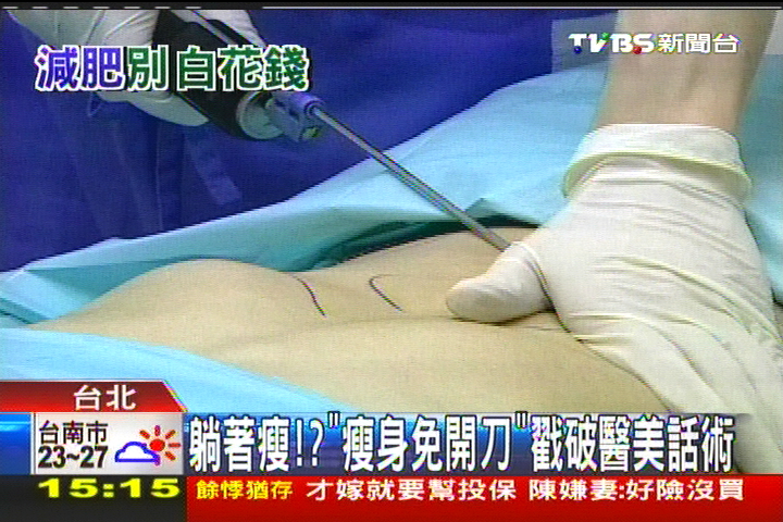 躺著瘦!? 「瘦身免開刀」戳破醫美話術