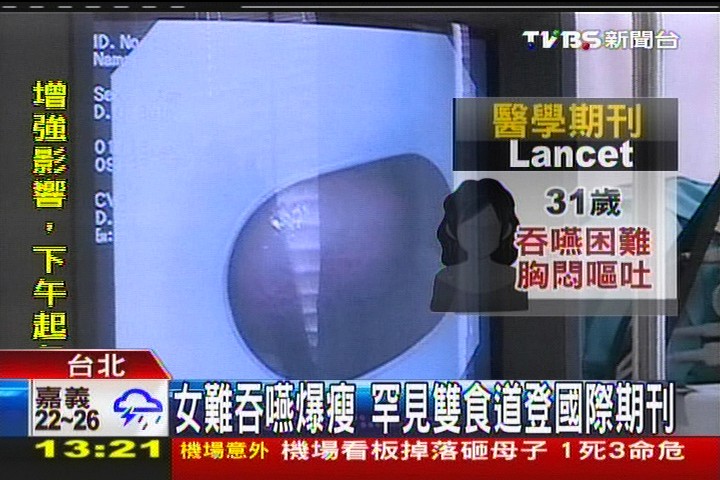 女難吞嚥爆瘦　罕見雙食道登國際期刊