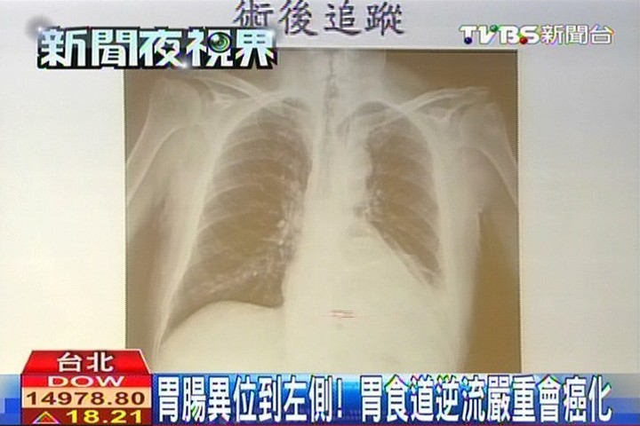 胃腸異位到左側! 胃食道逆流嚴重會癌化