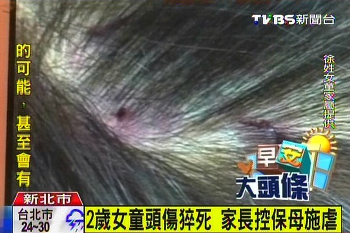 2歲女童頭傷猝死　家長控保母施虐